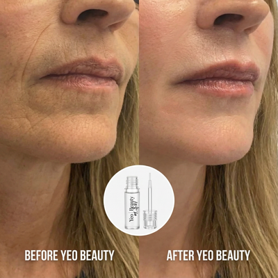 Micro Infusion System