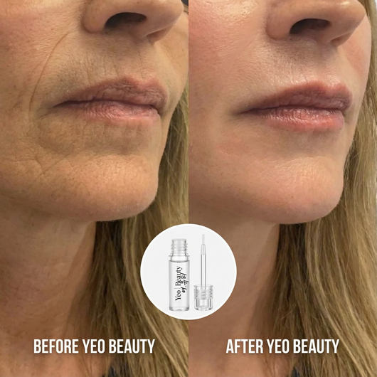 Micro Infusion System