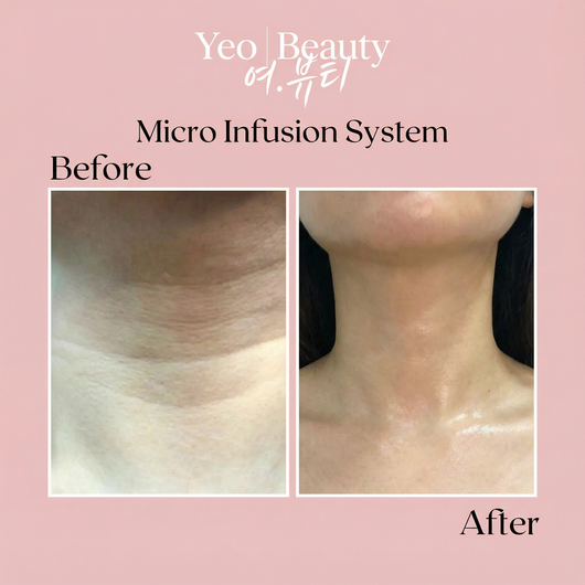 Micro Infusion System