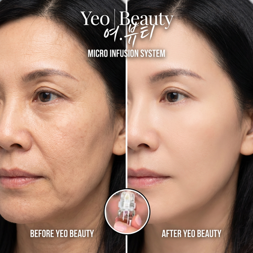 Micro Infusion System