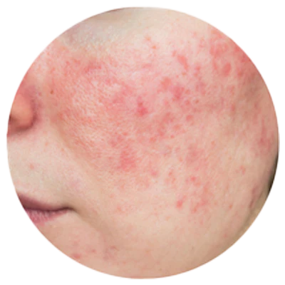 ACNE & ROSACEA